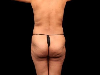 Brazilian Butt Lift Before & After Patient #355