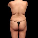 Brazilian Butt Lift Before & After Patient #362