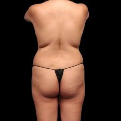 Brazilian Butt Lift Before & After Patient #362