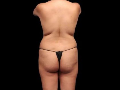 Brazilian Butt Lift Before & After Patient #362