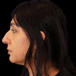 Rhinoplasty Before & After Patient #267