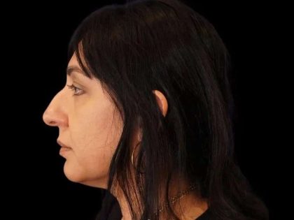 Rhinoplasty Before & After Patient #267