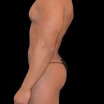 Brazilian Butt Lift Before & After Patient #365