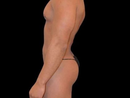 Brazilian Butt Lift Before & After Patient #365