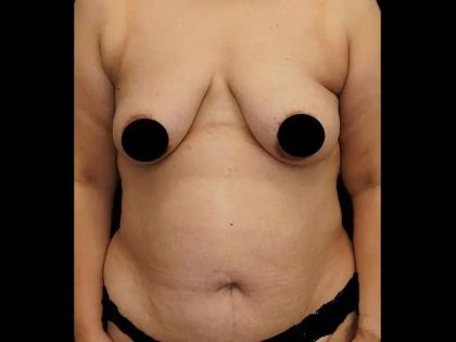 Tummy Tuck Before & After Patient #372