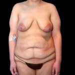 Tummy Tuck Before & After Patient #379