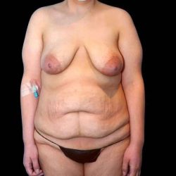 Tummy Tuck Before & After Patient #379