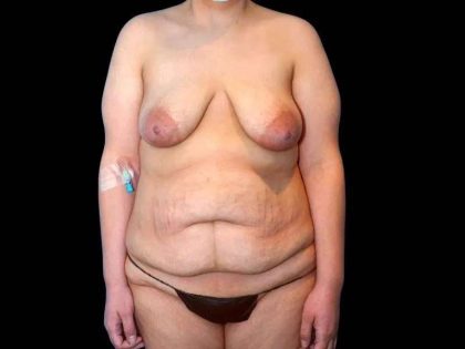 Tummy Tuck Before & After Patient #379