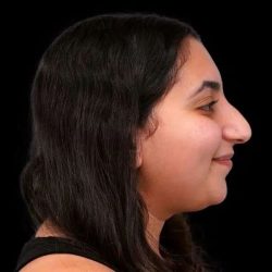 Rhinoplasty Before & After Patient #253
