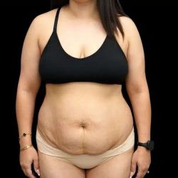 Tummy Tuck Before & After Patient #407