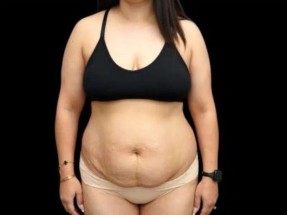 Tummy Tuck Before & After Patient #407