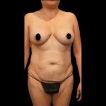 Tummy Tuck Before & After Patient #412
