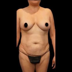 Tummy Tuck Before & After Patient #412