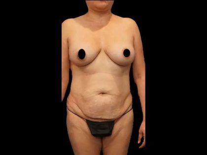 Tummy Tuck Before & After Patient #412