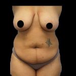 Tummy Tuck Before & After Patient #422