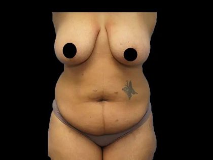 Tummy Tuck Before & After Patient #422
