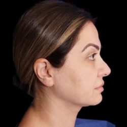 Rhinoplasty Before & After Patient #274