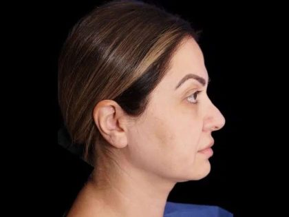 Rhinoplasty Before & After Patient #274