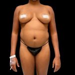 Liposuction Before & After Patient #434