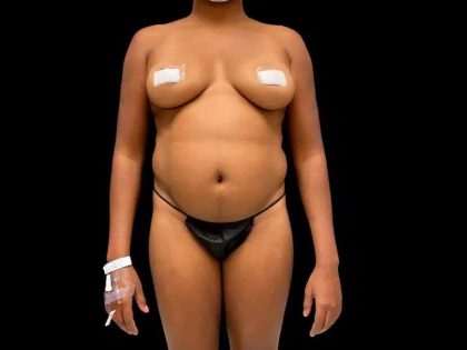 Liposuction Before & After Patient #434