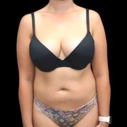 Liposuction Before & After Patient #451
