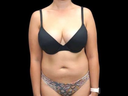 Liposuction Before & After Patient #451