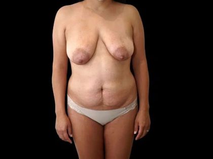 Mommy Makeover Before & After Patient #485