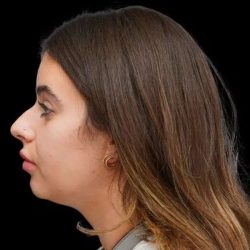 Rhinoplasty Before & After Patient #277