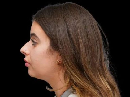 Rhinoplasty Before & After Patient #277