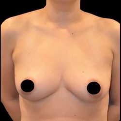 Breast Augmentation Before & After Patient #499