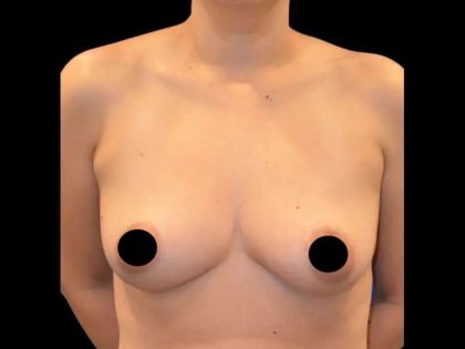 Breast Augmentation Before & After Patient #499