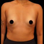 Breast Augmentation Before & After Patient #506