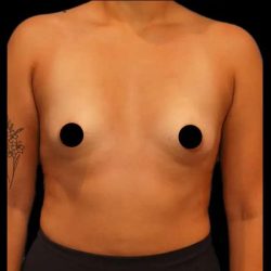 Breast Augmentation Before & After Patient #506