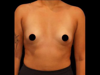 Breast Augmentation Before & After Patient #506