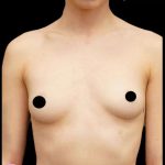 Breast Augmentation Before & After Patient #513