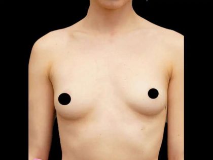 Breast Augmentation Before & After Patient #513