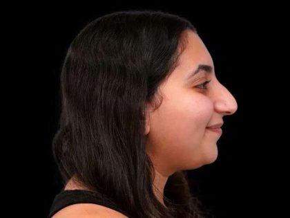 Rhinoplasty Before & After Patient #253