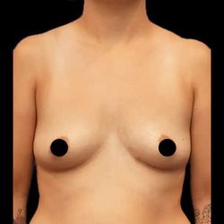 Breast Augmentation Before & After Patient #518