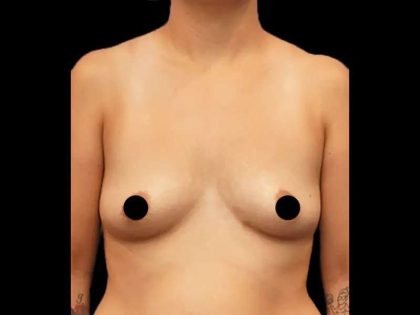 Breast Augmentation Before & After Patient #518