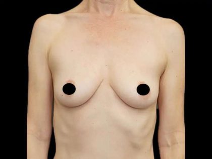 Breast Augmentation Before & After Patient #525
