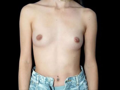 Breast Augmentation Before & After Patient #539
