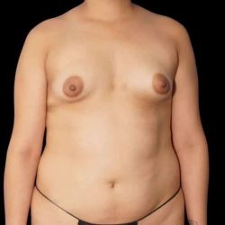 Breast Augmentation Before & After Patient #553