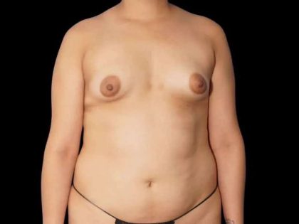 Breast Augmentation Before & After Patient #553