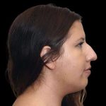 Rhinoplasty Before & After Patient #284