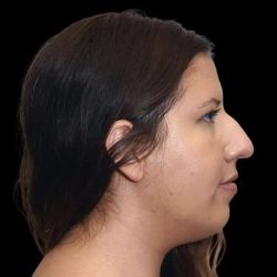 Rhinoplasty Before & After Patient #284