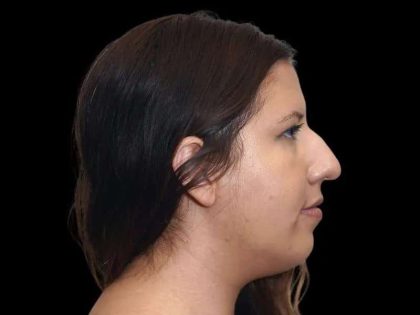 Rhinoplasty Before & After Patient #284