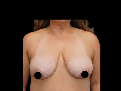 Breast Lift/Reduction Before & After Patient #581