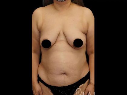 Breast Lift/Reduction Before & After Patient #587