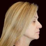 Rhinoplasty Before & After Patient #291