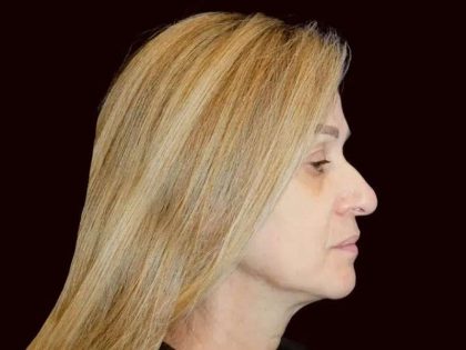 Rhinoplasty Before & After Patient #291